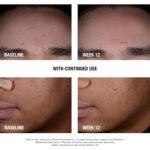 Neutrogena Stubborn Blackheads Daily Serum - 1.0 fl oz - Image 3