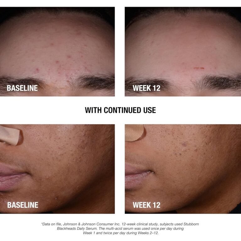 Neutrogena Stubborn Blackheads Daily Serum - 1.0 fl oz - Image 3